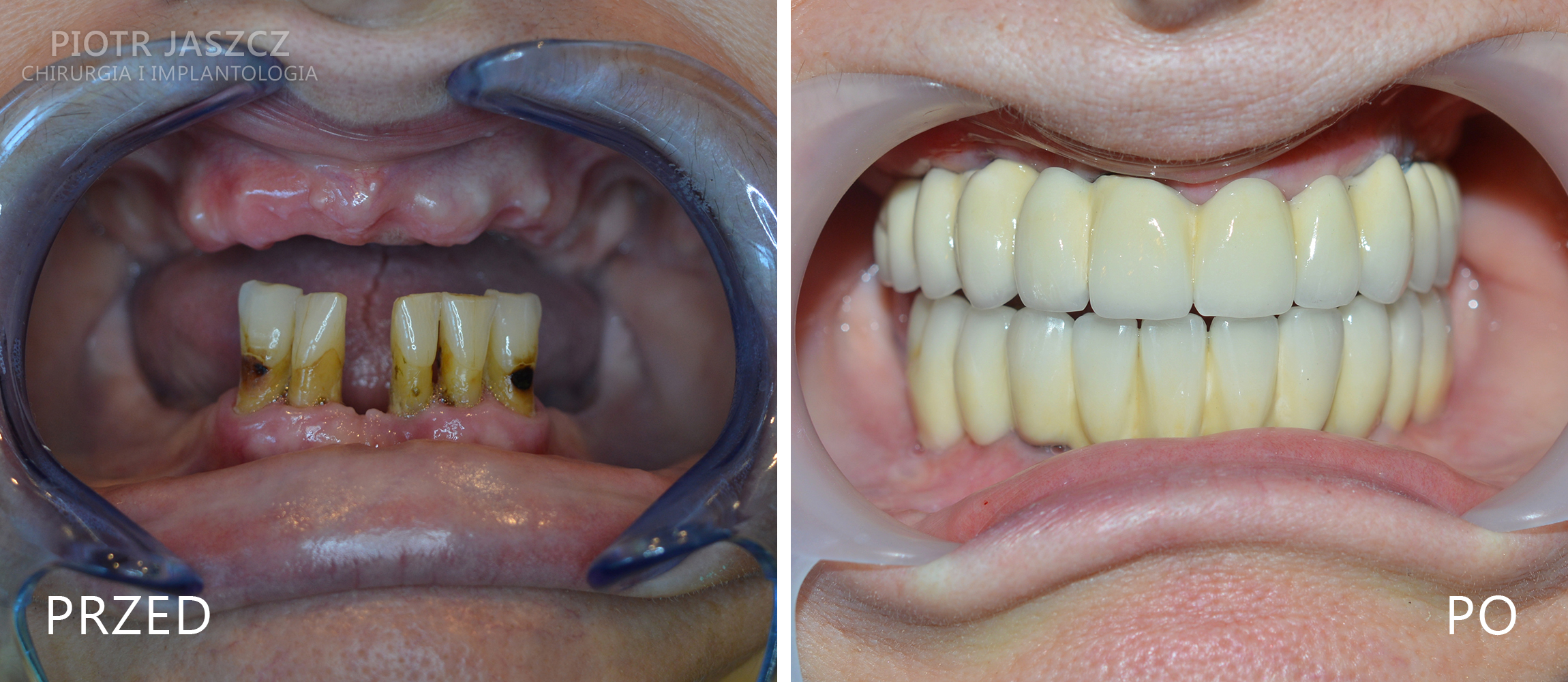 Usunięcie pięciu (ostatnich) zębów w żuchwie oraz wszczepienie 7 implantów w szczęce z jednoczesną regeneracją kości w zatokach szczękowych (prawej i lewej) oraz 5 implantów w żuchwie. Widoczny most ostateczny w szczęce oparty na 7 implantach oraz most ostateczny w żuchwie oparty na 5 implantach.