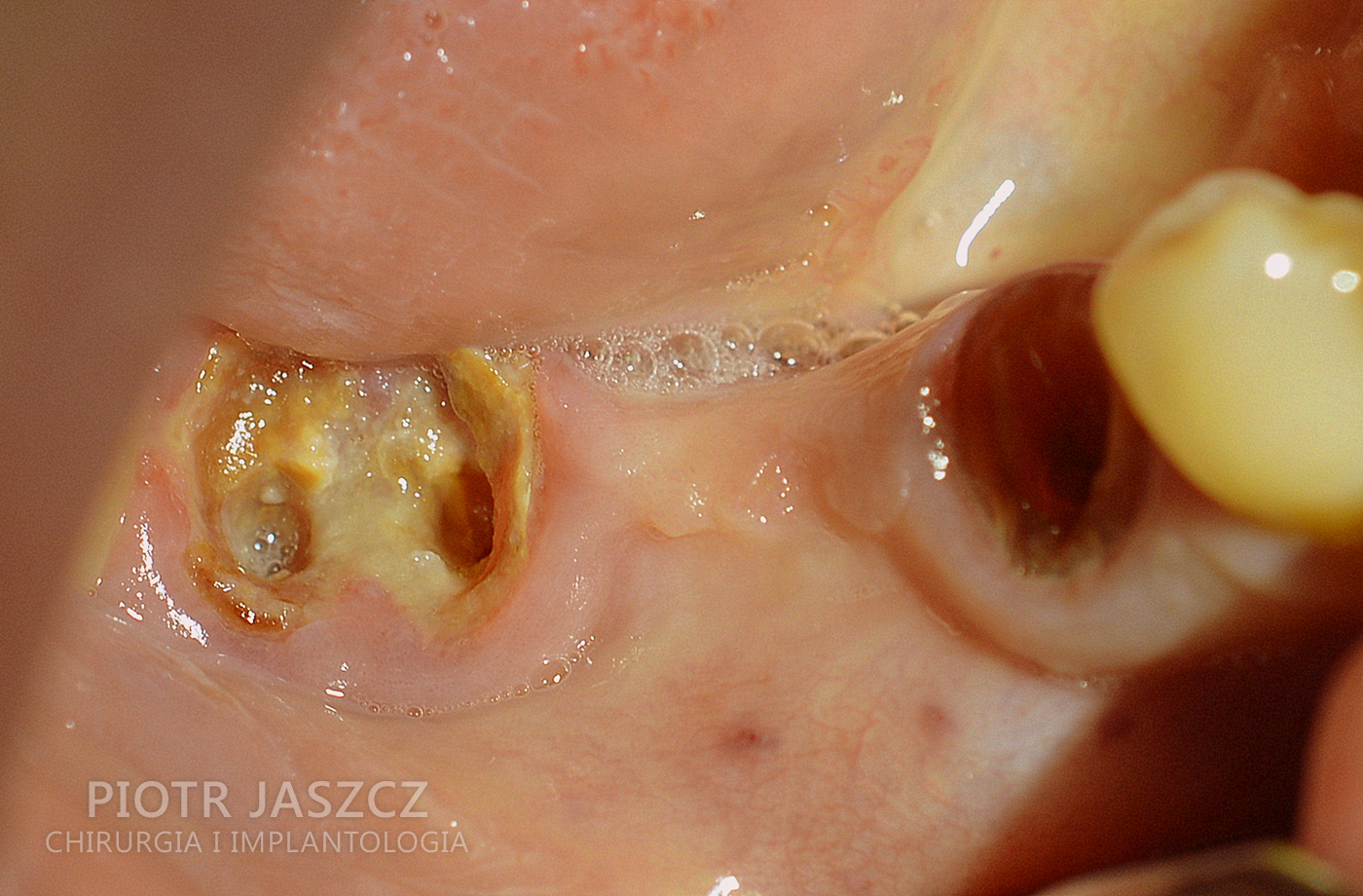Usunięcie dwóch korzeni zębów dolnych z jednoczesnym wszczepieniem dwóch implantów oraz regeneracją kości przy użyciu materiału kościozastępczego oraz kości autogennej. Widoczny most ostateczny na dwóch implantach odtwarzający 3 zęby w żuchwie.