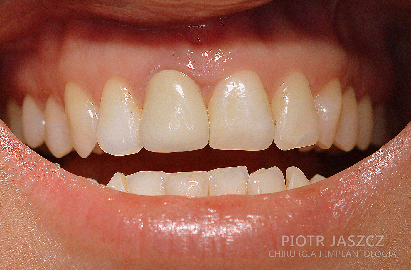 Resorpcja zewnętrzna korony i korzenia jedynki górnej prawej pacjenta. Usunięcie zęba z jednoczesnym wszczepieniem implantu oraz regeneracją kości horyzontalnie ( poziomo ) przy użyciu membrany kolagenowej i materiału kościozastępczego. Widoczna korona ostateczna na implancie. 