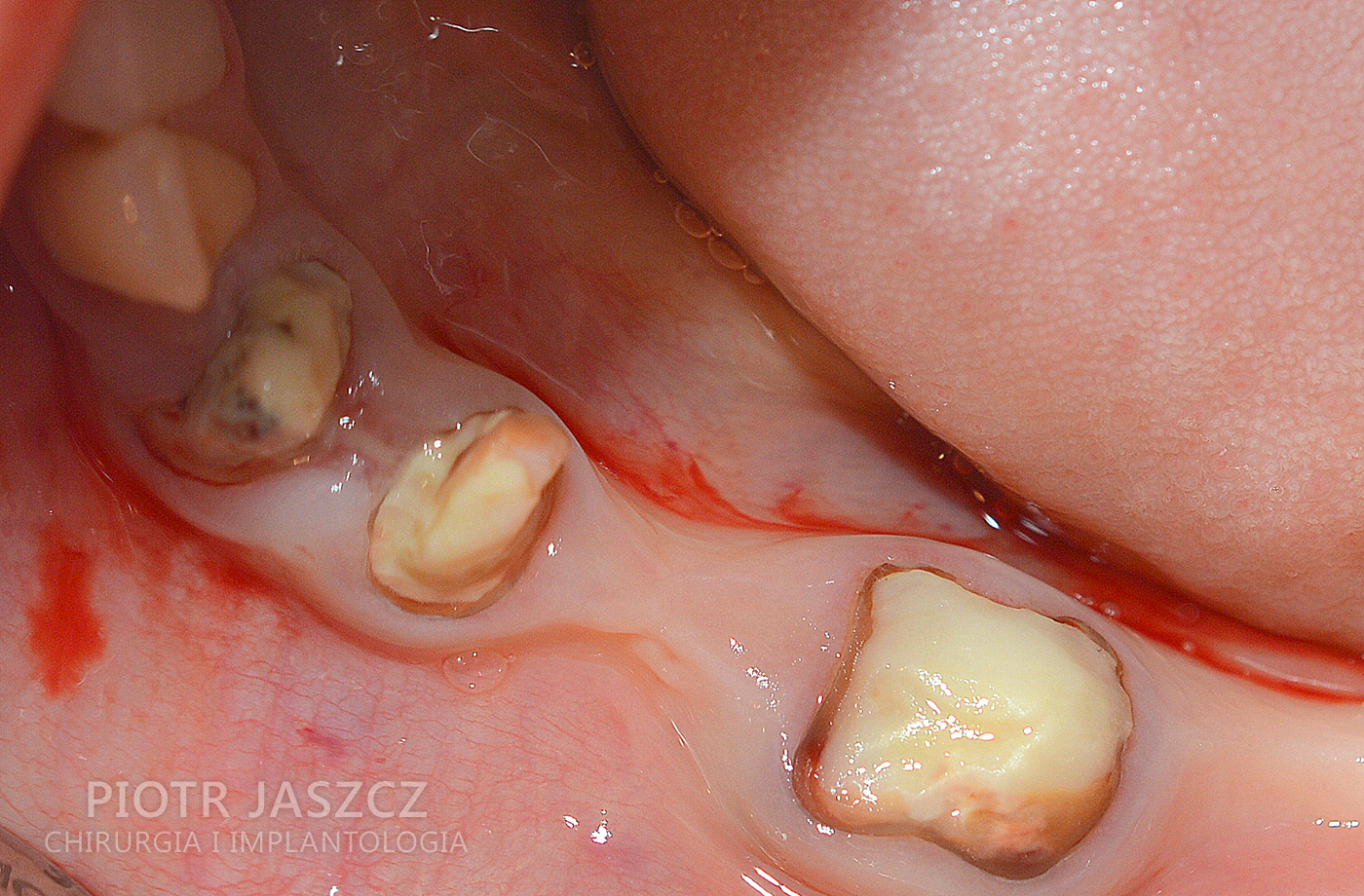 Usunięcie trzech zębów dolnych z jednoczesnym wszczepieniem trzech implantów oraz regeneracją kości przy użyciu materiału kościozastępczego oraz kości autogennej. Widoczny most ostateczny na trzech implantach odtwarzający 4 zęby w żuchwie.